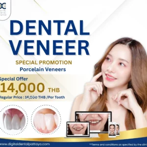 6 Teeth Porcelain Veneers Package at DGT