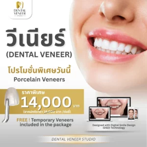6 Teeth High-Quality Porcelain Ceramic Veneers at DVS